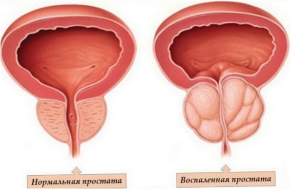 Infiammazione della prostata
